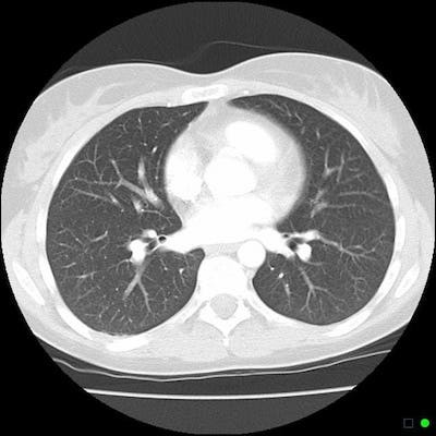 Компьютерная томография лёгких